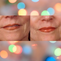 Derma-Roller-for-Lip-Wrinkles-before-and-after 